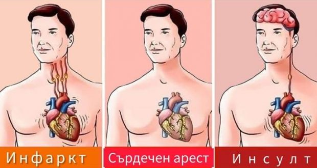 Как да окажем първа помощ при инсулт, инфакт, сърдечен арест