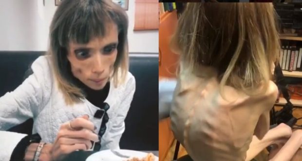Преди 8 години тя тежеше само 17 кг! Ето как изглежда момичето-скелет днес (СНИМКИ):